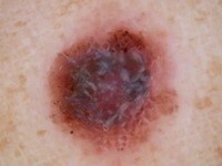 Nodular Melanoma-1-1