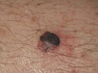 Nodular melanoma (1)-1-1-2