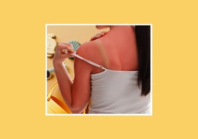 sunburn damage control