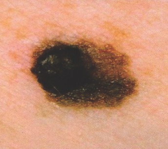 Moles: What’s normal and what’s suspicious?