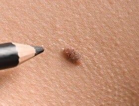 Mole removal image