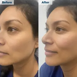 dermal filler - cheek - before and after