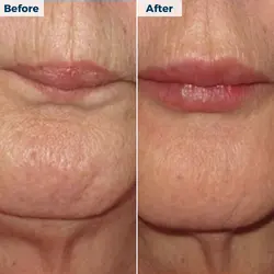 lip filler before and after 2 250 x 250 px webp